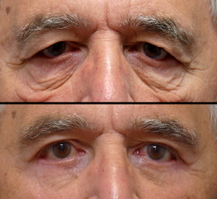 Blepharoplasty Surgery for Men Results North New Jersey