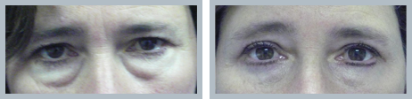 Blepharoplasty Surgery Results North New Jersey