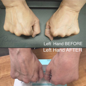 restylane for hands before and after