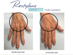 restylane for hands