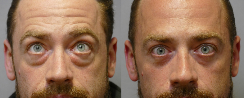 Blepharoplasty before and after Photo
