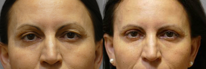 Blepharoplasty before and after Photo
